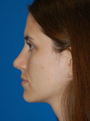 Female face, after Rhinoplasty treatment, l-side view, patient 484