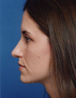 Female face, before Rhinoplasty treatment, l-side view, patient 484