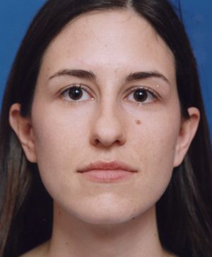 Female face, before Rhinoplasty treatment, front view, patient 484