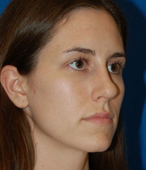 Female face, after Rhinoplasty treatment, r-side oblique view, patient 484