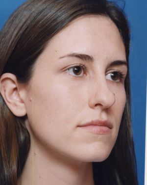 Female face, before Rhinoplasty treatment, r-side oblique view, patient 484