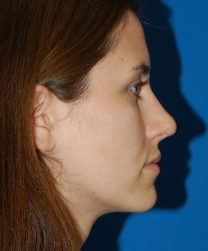Female face, after Rhinoplasty treatment, r-side view, patient 484