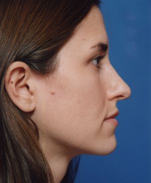 Female face, before Rhinoplasty treatment, r-side view, patient 484