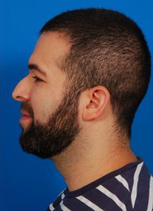 Male face, before Rhinoplasty treatment, l-side view, patient 5