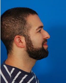 Male face, before Rhinoplasty treatment, r-side view, patient 5