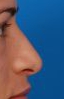 Female nose, before Rhinoplasty treatment, r-side view, patient 6
