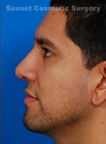 Male face, after Rhinoplasty (revision) treatment: l-side view, patient 1