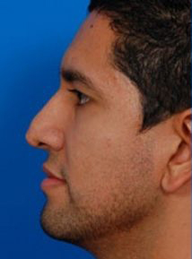 Male face, before Rhinoplasty (revision) treatment: l-side view, patient 1