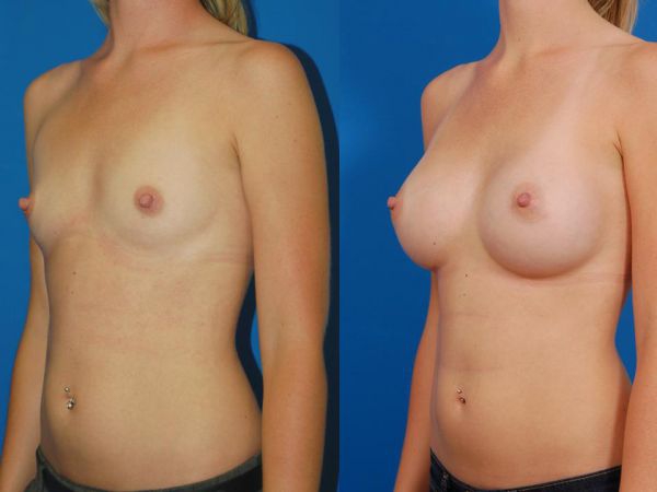 Woman's breasts, before and after Silicone Breast Augmentation treatment in LA, l-side oblique view - patient 6