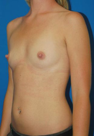 Woman's breasts, before Silicone Breast Augmentation treatment in LA, l-side oblique view, patient 6