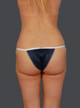 Woman's body, after Brazilian Butt Lift treatment, b-side view, patient 10