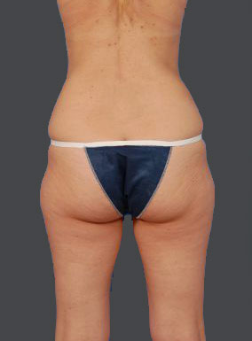 Woman's body, before Brazilian Butt Lift treatment, b-side view, patient 10