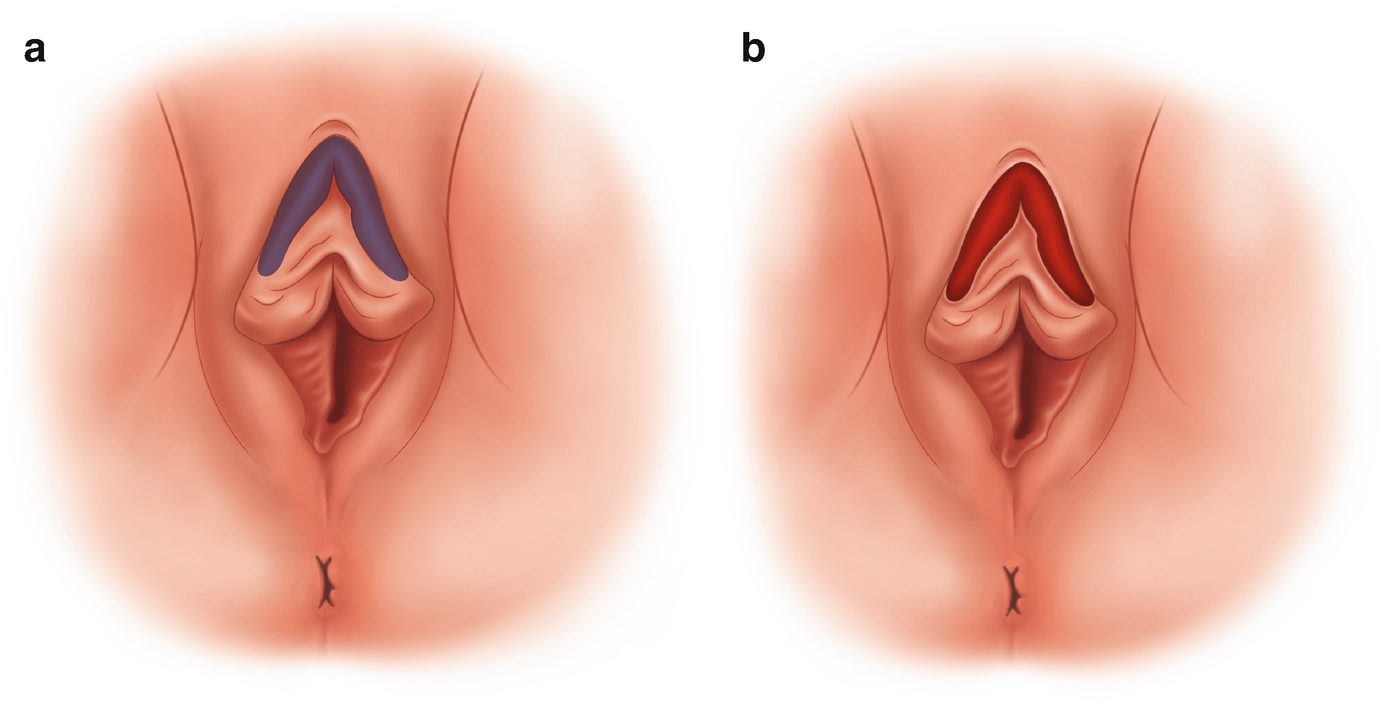 CLITORAL HOOD REDUCTION before and after treatment