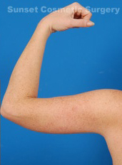 Woman's hand, after Arm Lift treatment, back view (l-hand), patient 2