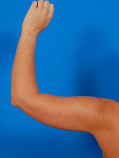 Woman's hand, before Arm Liposuction treatment, back view (l-hand), patient 10