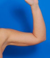 Woman's hand, after Arm Liposuction treatment, front view (l-hand), patient 10