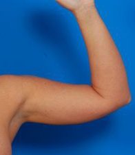 Woman's hand, before Arm Liposuction treatment, front view (l-hand), patient 10