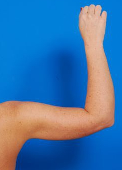 Woman's hand, after Arm Liposuction treatment, back view (r-hand), patient 10