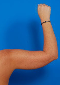 Woman's hand, before Arm Liposuction treatment, back view (r-hand), patient 10