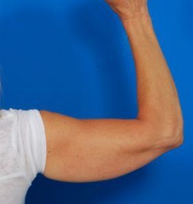 Woman's hand, before Arm Liposuction treatment, back side view (r-hand), patient 6