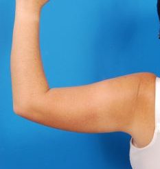 Woman's hand, before Arm Liposuction treatment, back view (l-hand), patient 8