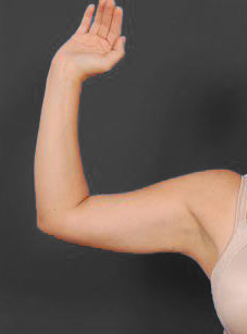 Woman's hand, after Arm Liposuction treatment, front view (r-hand), patient 8