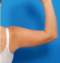 Woman's hand, before Arm Liposuction treatment, back view (r-hand), patient 8