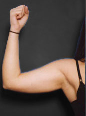 Woman's hand before Arm Liposuction treatment, front view, patient 1