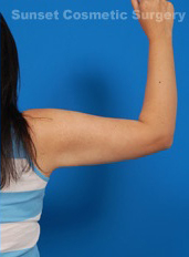 Woman's hand after Arm Liposuction treatment, back side view, patient 4