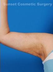 Woman's hand after Arm Liposuction treatment, front view, patient 4