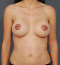 Woman's breasts, after Breast Lift treatment, front view, patient 12