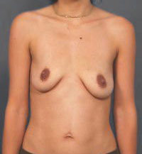 Woman's breasts, before Breast Lift treatment, front view, patient 12