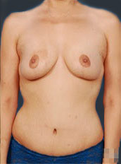 Woman's body, after Body Lift treatment, front view, patient 2