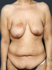 Woman's body, before Body Lift treatment, front view, patient 2