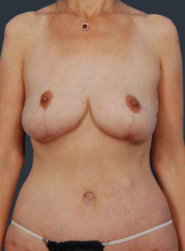 Woman's body, after Body Lift treatment, front view, patient 3