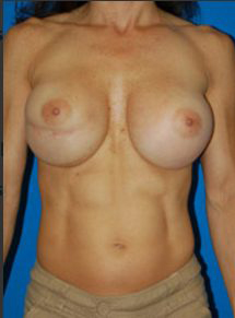 Woman's breasts, before Breast Asymmetry treatment, front view, patient 2