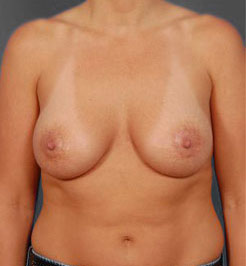 Woman's breasts, after Breast Lift treatment, front view, patient 14