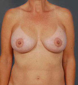 Woman's breasts, after benelli breast lifts treatment, front view, patient 2