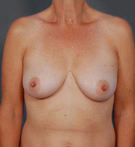 Woman's breasts, before benelli breast lifts treatment, front view, patient 2