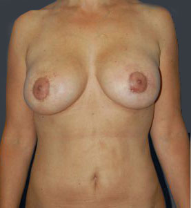 Woman's breasts, after Breast Lift treatment, front view, patient 1