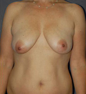 Woman's breasts, before Breast Lift treatment, front view, patient 1