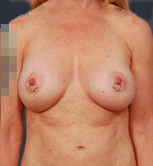 Woman's breasts, after Breast Lift treatment, front view, patient 10