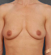 Woman's breasts, before Breast Lift treatment, front view, patient 2