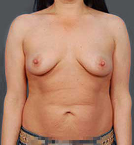 Woman's breasts, before Breast Lift treatment, front view, patient 3