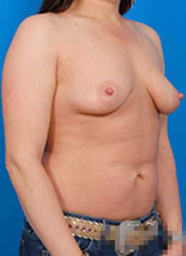 Woman's breasts, before Breast Lift treatment, r-side oblique view, patient 3