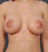 Woman's breasts, after Benelli Mastopexy treatment, front view, patient 4