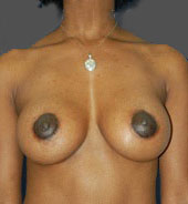 Woman's breasts, after Breast Lift treatment, front view, patient 5