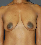 Woman's breasts, before Breast Lift treatment, front view, patient 5