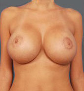 Woman's breasts, after Breast Lift treatment, front view, patient 7