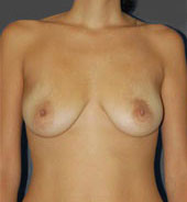 Woman's breasts, before Breast Lift treatment, front view, patient 7